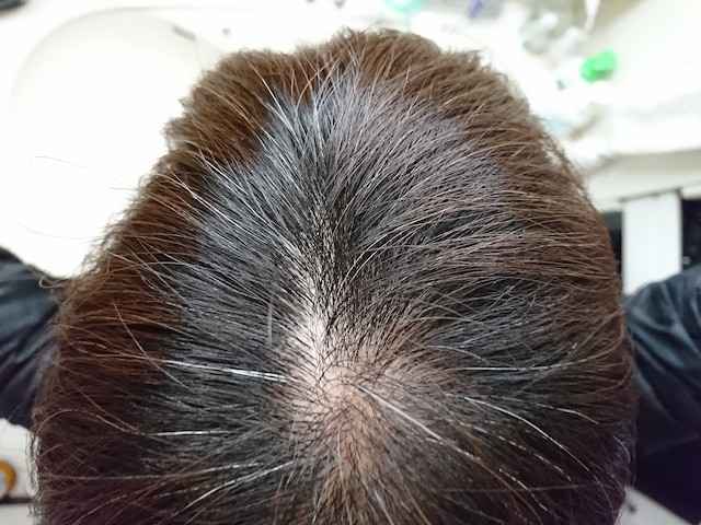 男性型脱毛症（AGA）治療の今！